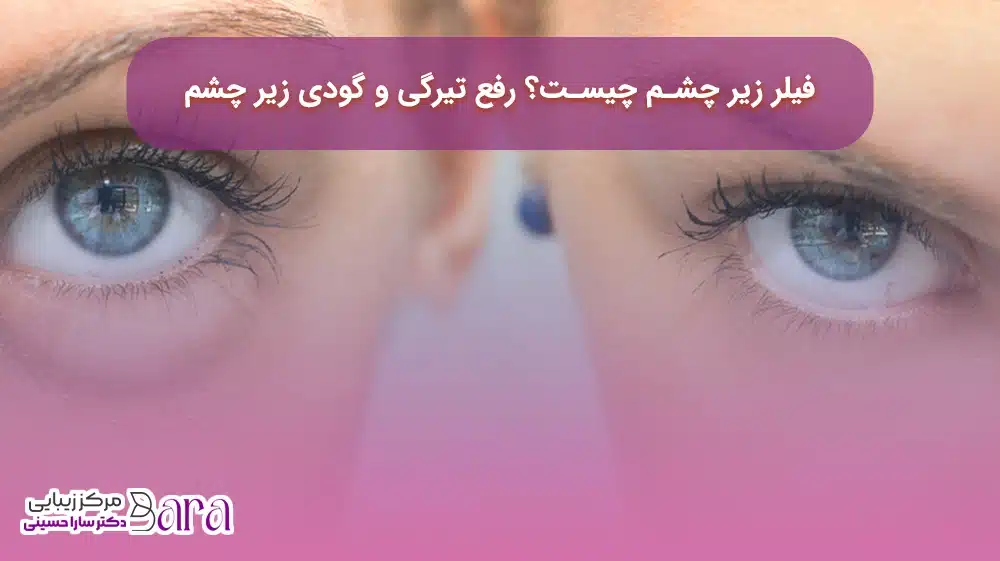 فیلر زیر چشم چیست