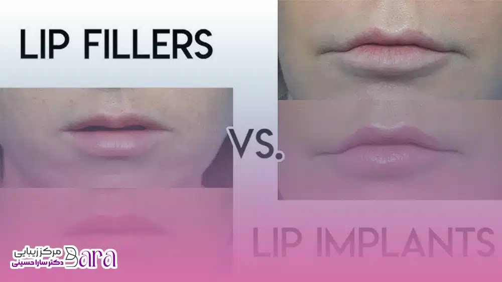 تفاوت فیلر لب با پروتز لب در کلینیک دکتر حسینی