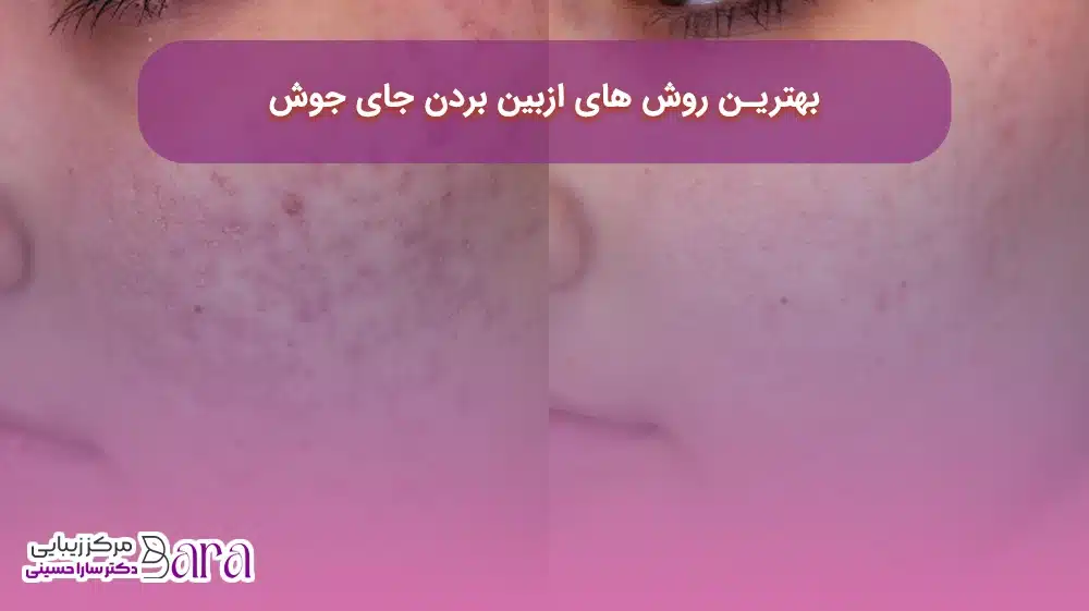 بهترین روش‌های از بین بردن جای جوش در بلاگ زیبایی سارا حسینی