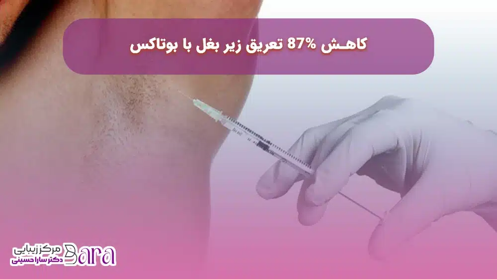 بوتاکس درمانی برای کاهش عرق کردن