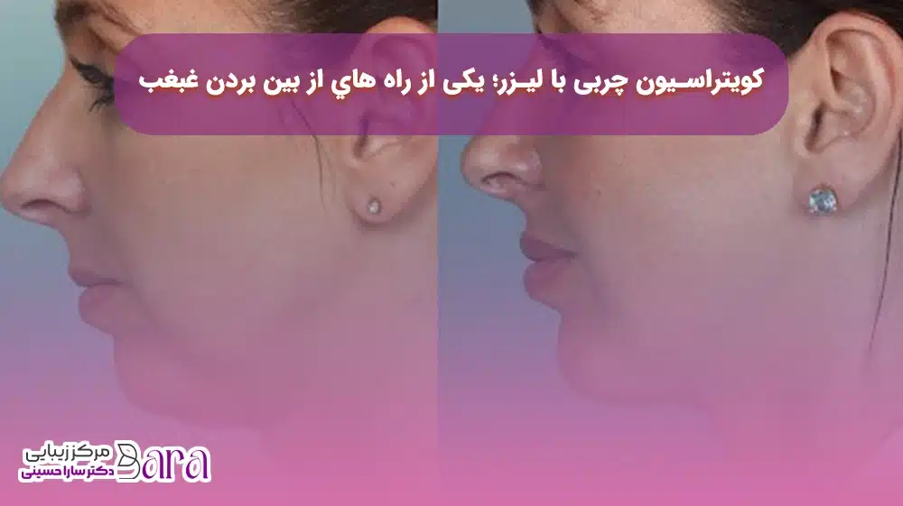 کویتراسیون چربی با لیزر؛ یکی از راه هاي از بين بردن غبغب