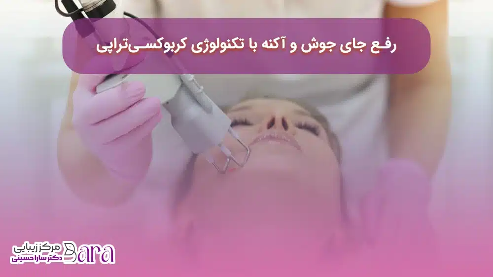 کربوکسی تراپی در از بین بردن جای جوش