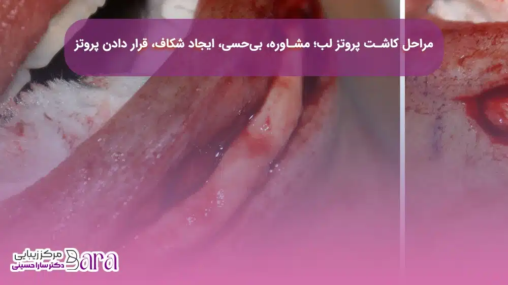 مراجل انجام پروتز لب از تفاوت های بین پروتز لب و فیلر لب