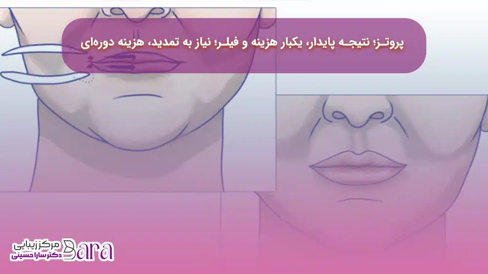هزینه ها از تفاوت بین فیلر و پروتز لب