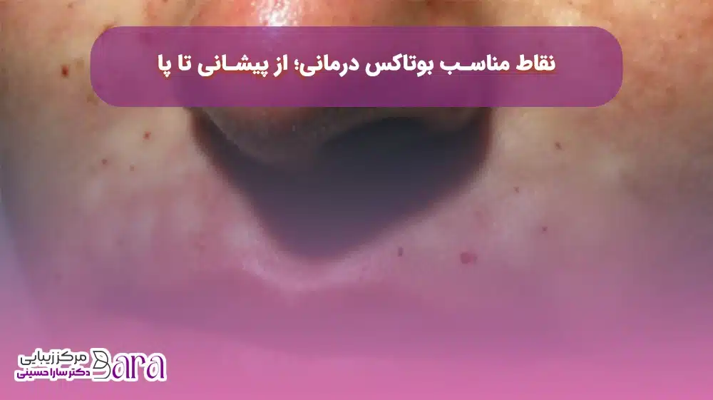نقاط مناسب تزریق بوتاکس ضد عرق