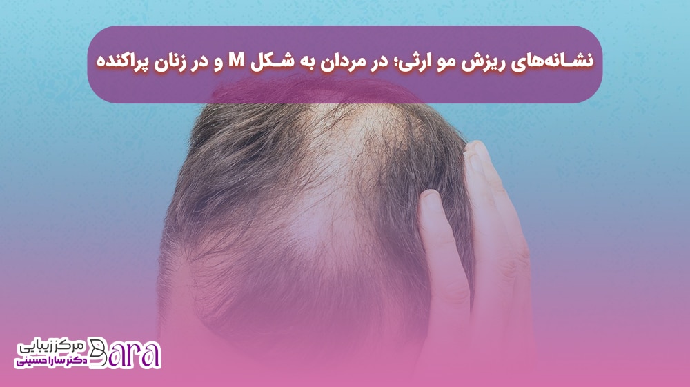 نشانه های ریزش مو ارثی