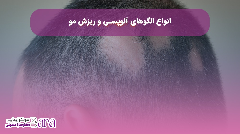انواع ریزش مو
