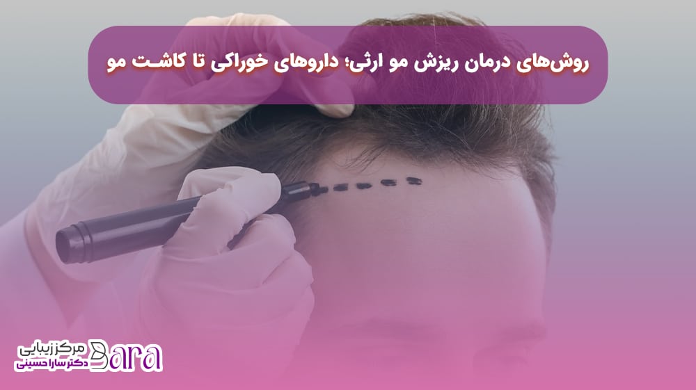 درمان ریزش مو ارثی